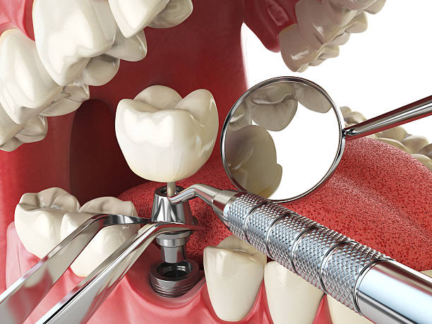 Best Emergency Broken Tooth Repair in Horizon City, TX